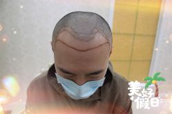 -大麦微针植发全国连锁