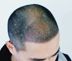 -大麦微针植发全国连锁
