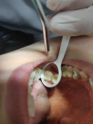 体验后-深圳春天阳光医院·轮廓抗衰中心