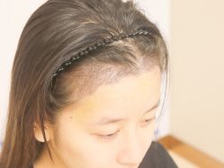 -大麦微针植发全国连锁