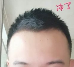 -大麦微针植发丨全国连锁