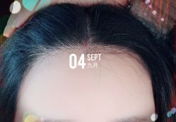 -大麦微针植发全国连锁