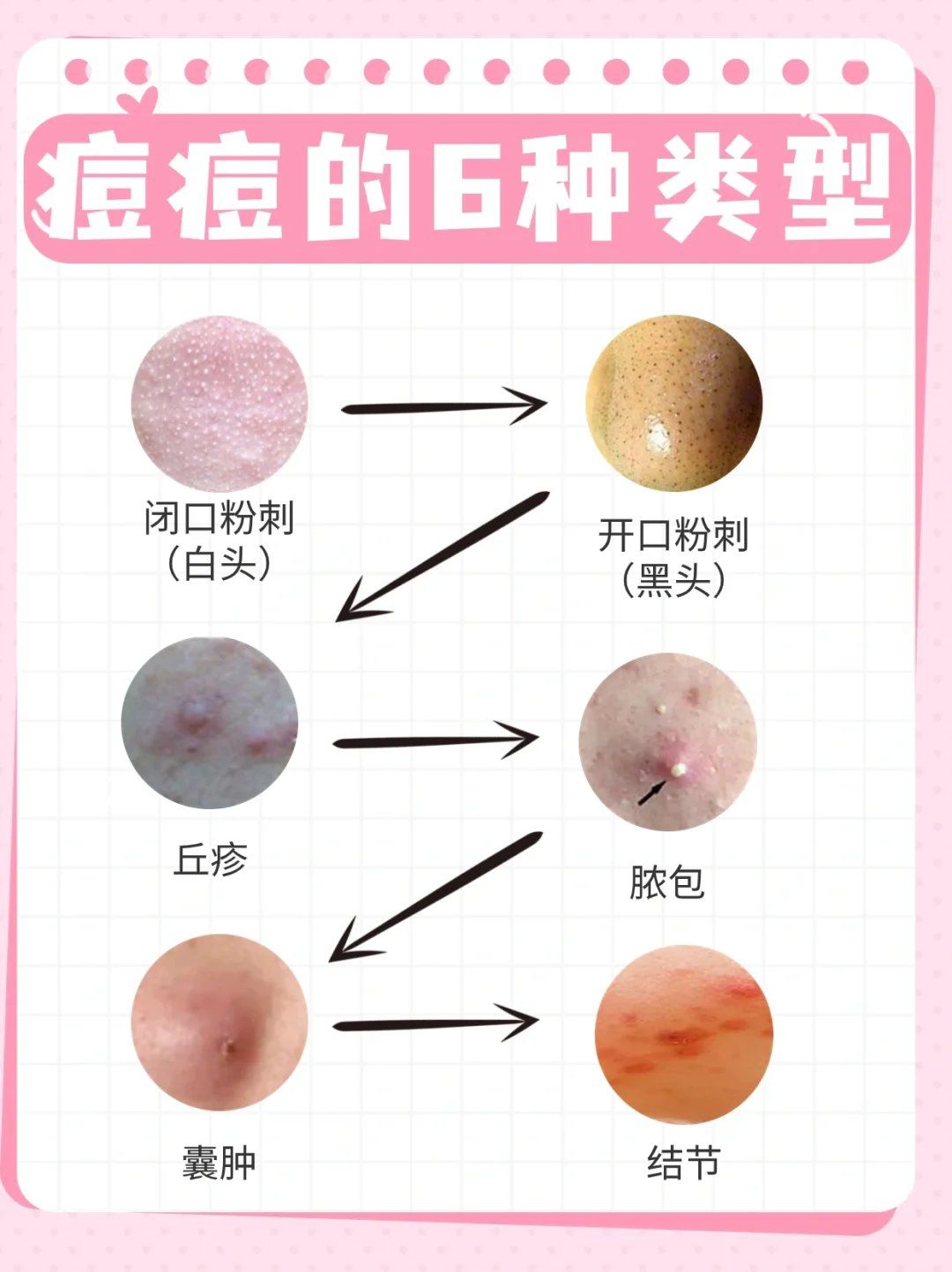 痘痘到底能不能挤⁉别在盲目挤痘了哦❗