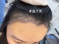 -大麦微针植发全国连锁