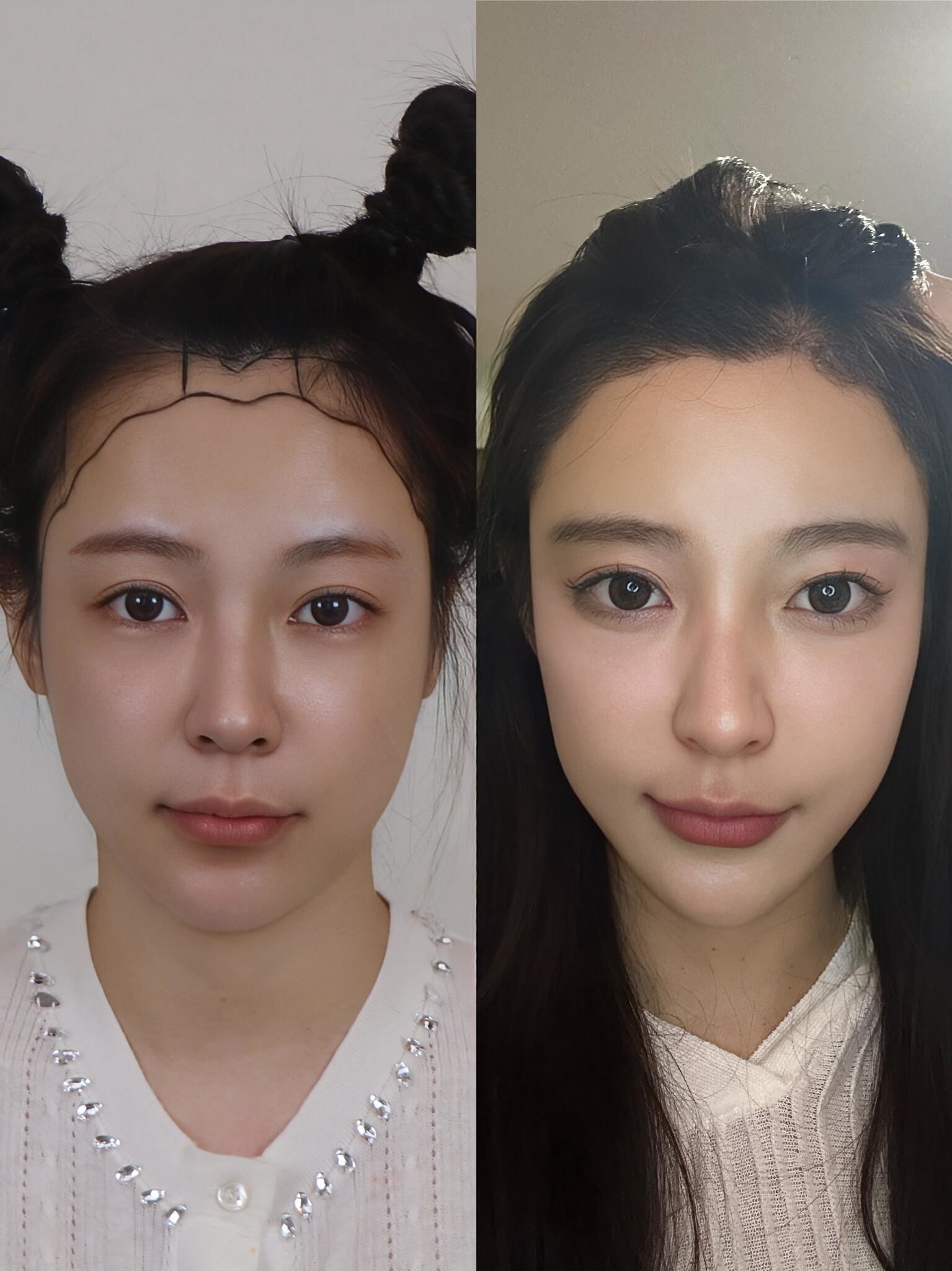 中庭比较长不适合太低的
还有一个就是轮廓
弧度比较大发际线看