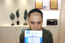 -大麦微针植发丨全国连锁