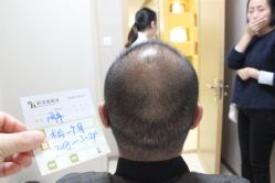 点击看大图 -大麦微针植发丨全国连锁