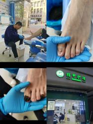 -德哥灰指甲脚气甲沟炎跖疣护理