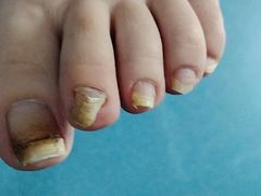 -祖传修脚甲沟炎灰指甲鸡眼