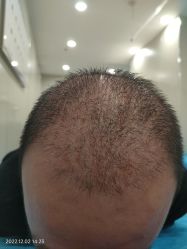 -碧莲盛·不剃发植发