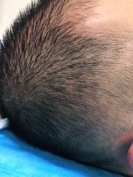 -碧莲盛·不剃发植发