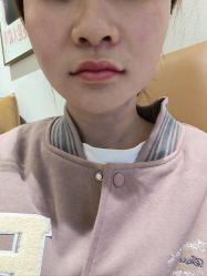 点击看大图 体验后-深圳米兰柏羽医疗美容医院