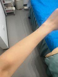 体验后-杭州整形医院·国际部