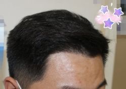 -大麦微针植发丨全国连锁