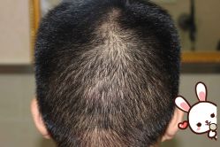 -大麦微针植发丨全国连锁