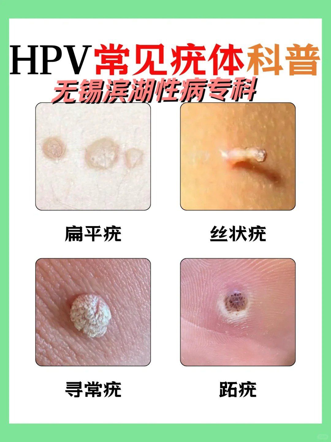 无锡市治疗hpv医院:hpv常见疣体科普