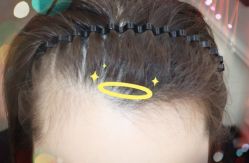 -大麦微针植发全国连锁