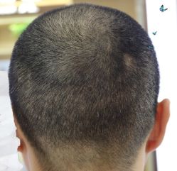 -大麦微针植发丨全国连锁