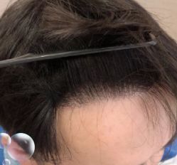 -大麦微针植发丨全国连锁