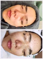 -瓷肌博士·祛痘科技美肤