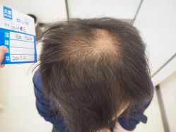 -大麦微针植发丨全国连锁