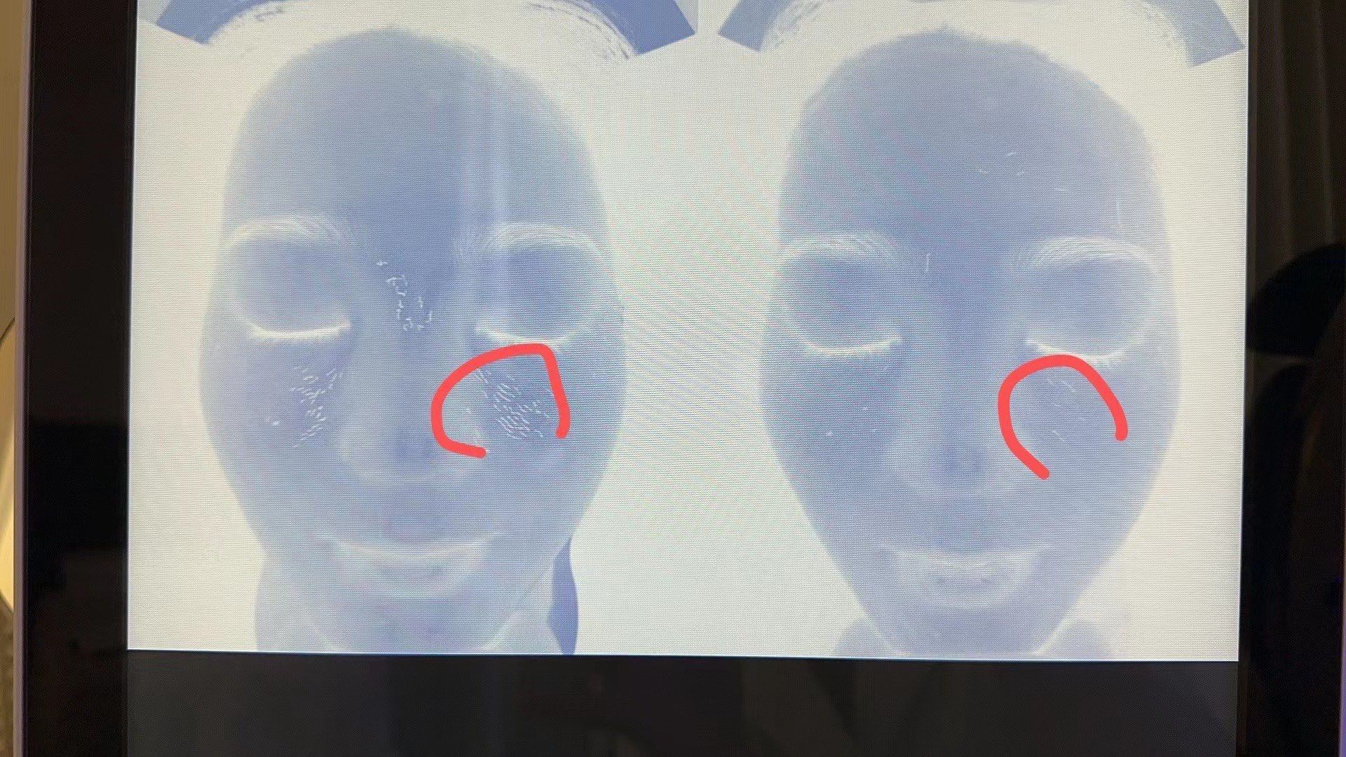 弹力纤维断裂会引起皮肤松弛下垂
毛孔