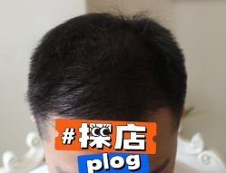 -大麦微针植发丨全国连锁