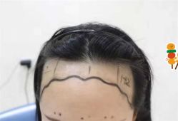 -大麦微针植发全国连锁