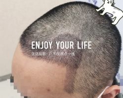 -大麦微针植发全国连锁