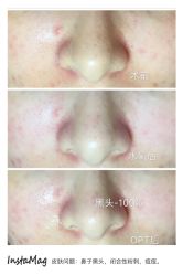 opt光疗-光SPA科技美肤