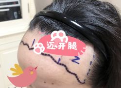 -大麦微针植发全国连锁