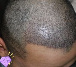 -大麦微针植发丨全国连锁