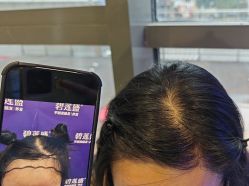 -碧莲盛·不剃发植发