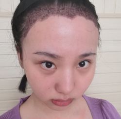 -碧莲盛·不剃发植发