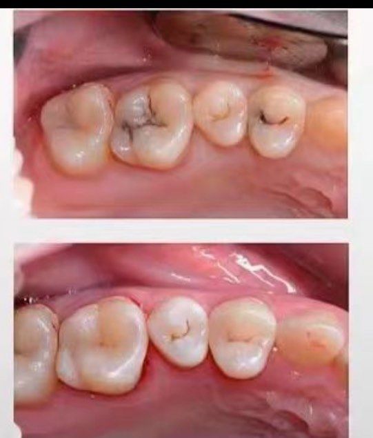 看看自己的牙齿有没有黑线呢!