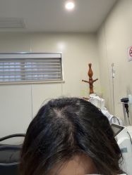 -碧莲盛·不剃发植发