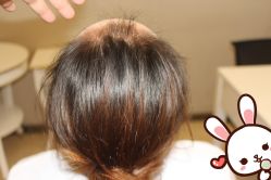 点击看大图 -大麦微针植发丨全国连锁