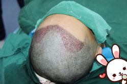 点击看大图 -大麦微针植发丨全国连锁