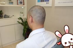 -大麦微针植发丨全国连锁