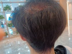 -碧莲盛·不剃发植发