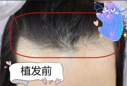 -大麦微针植发全国连锁