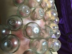 拔罐-沈师傅盲人按摩工作室(密三小区店)