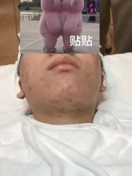 -塑青春&伊肤泉祛痘皮肤管理
