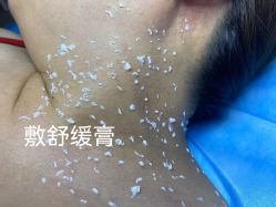 -爱莎扁平疣·汗管瘤·斑痣中心
