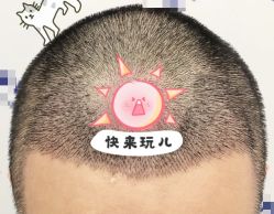 -大麦微针植发全国连锁