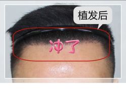 -大麦微针植发全国连锁