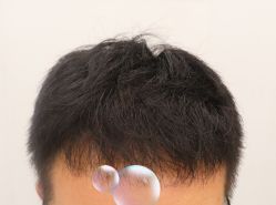 -大麦微针植发全国连锁