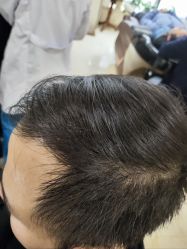 -碧莲盛·不剃发植发