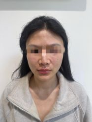 体验后-杭州美莱医疗美容医院