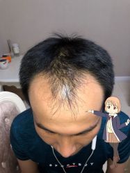 -大麦微针植发丨全国连锁